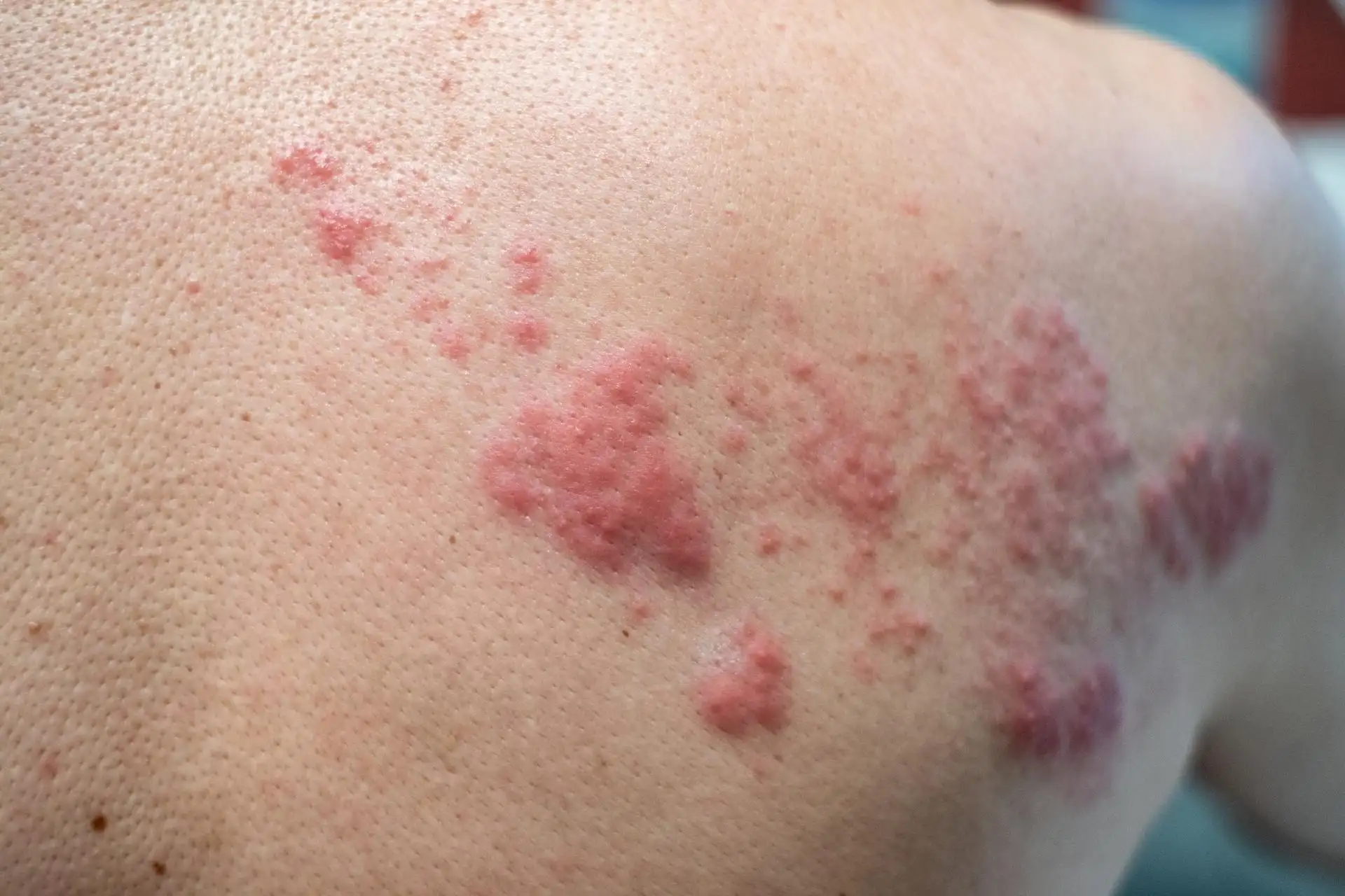 Bullous Pemphigoid